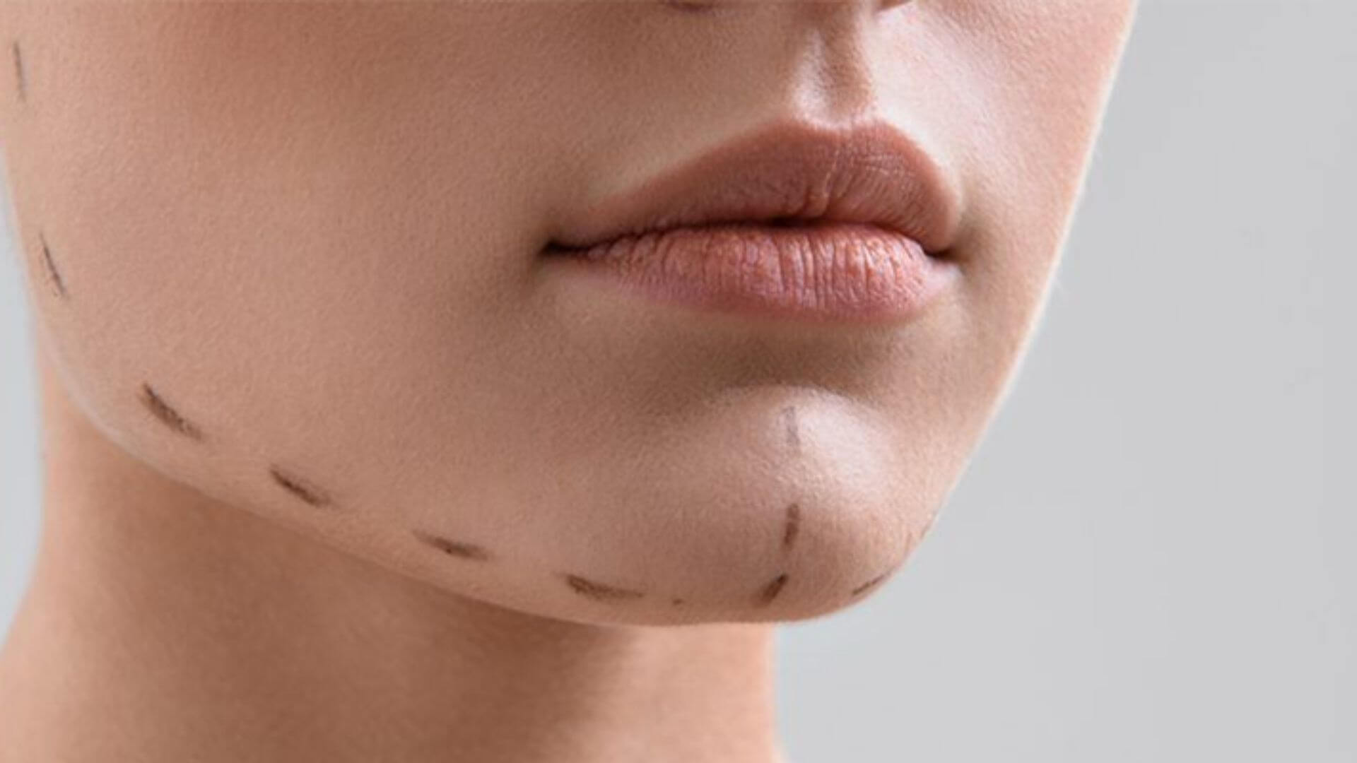Gıdı Liposuction Hakkında Bilmeniz Gerekenler