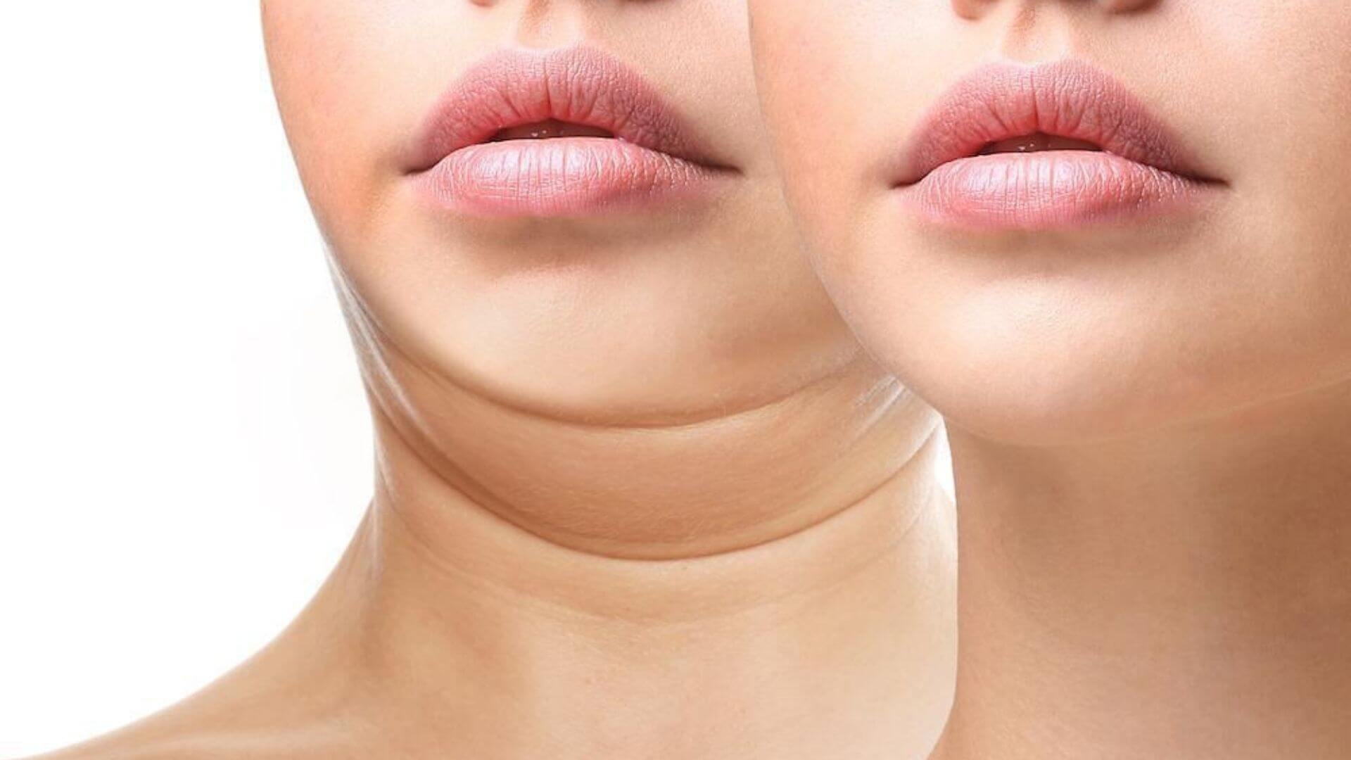 Gıdı Liposuction Hakkında Bilmeniz Gerekenler